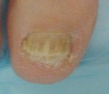 nail fungus